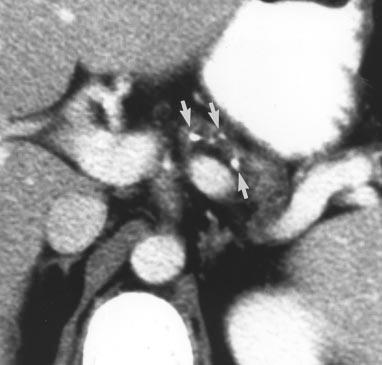 , On subsequent contrast-enhanced CT, calcified concretions in pancreatic body and tail are seen.