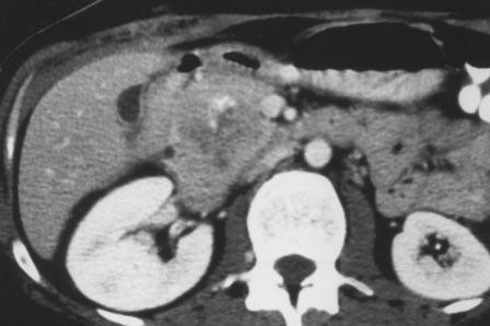 , On CT scan, small calcification is present in dilated main pancreatic duct (arrow). lso note dilated intrahepatic biliary ducts.