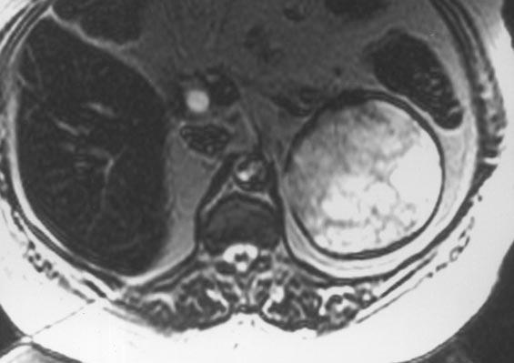 smaller calcifications (arrows) also visualized.
