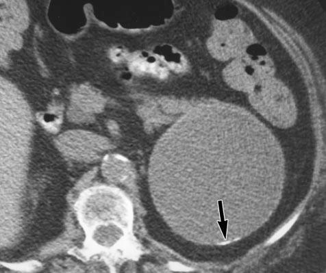 On endoscopic retrograde pancreatogram (not shown), other, noncalcified, mucinous filling defects were seen. Fig. 9.