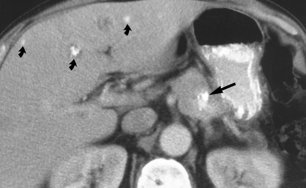 cyst (arrowhead). Fig. 12. Pancreatic metastases in 63-year-old man with mucinous colon carcinoma.