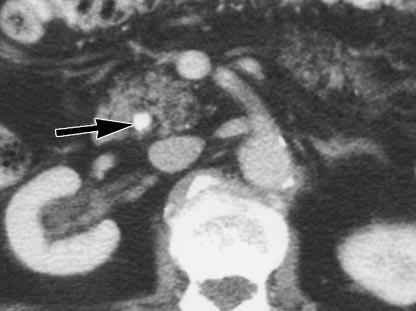 calcifications in liver (curved arrows). iopsies showed both liver and pancreatic lesions were metastatic.