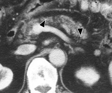 Senescent pancreatic calcifications in 77-year-old man without significant medical history who presented