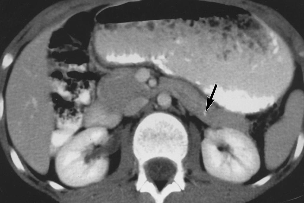 The most common sources are breast, lung, kidney, melanoma, and colon cancer. Calcifications have been reported in cases of metastatic renal cell carcinoma and metastatic colon carcinoma [10] (Fig.
