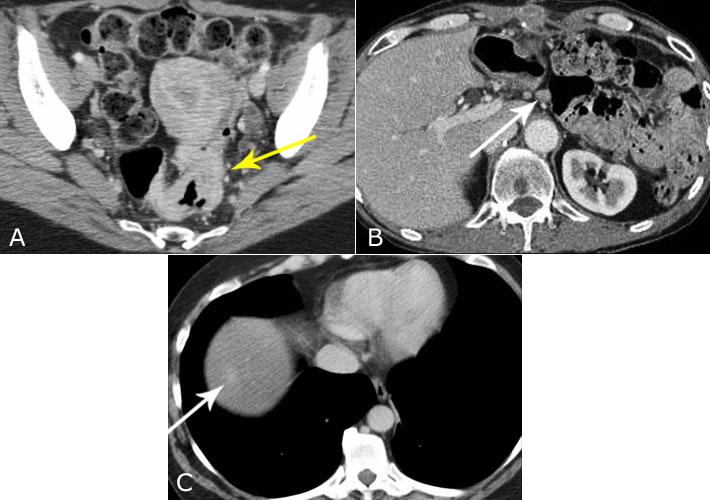 Figure 1. Initial Staging of Colorectal Cancer with CT. (A) Pelvic image shows site of the primary tumor (arrow).