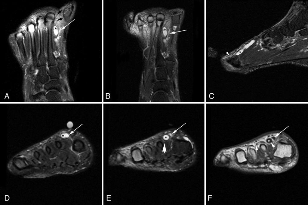 FIGURE 1 Magnetic resonance imaging of intraneural ganglion cyst.