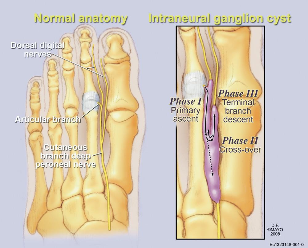 deep peroneal nerve (asterisk, medial digital branch of the second toe; white arrow, lateral digital branch of the hallux), extending proximally to the common digital nerve to the base of the first