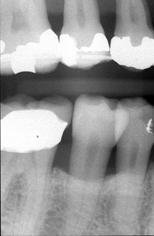 Moderate Marginal Periodontitis! Generalized form demonstrates horizontal bone loss! Localized defects include vertical bone loss and loss of buccal and lingual cortices!