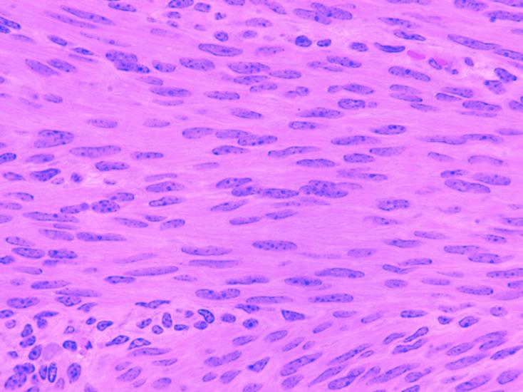 Smooth muscle cells lack sarcomeres. In contrast to skeletal and cardiac muscle cells, smooth muscle cells lack sarcomeres.