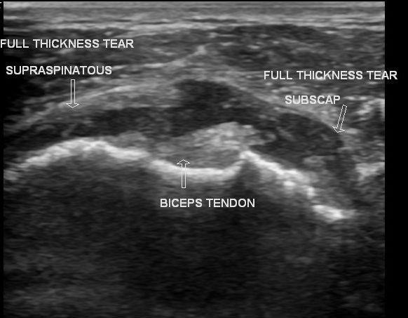 RC Imaging MSK ultrasound thought to be gold standard by some Can do dynamic testing when muscle in motion Tendon