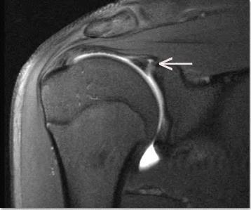 Labral Tears Traumatic: FOOSH, hyperextension, seat belt Overuse accentuates internal impingement Symptoms: painful click, popping, catching, pain with overhead