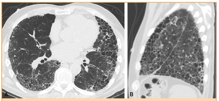 IPF Diagnosis Early diagnosis is important due to poor prognosis High-resolution computed tomography (HRCT) Surgical lung biopsy (not