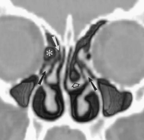 Three-dimensional volume-rendered of frontal sinus and frontal recess region., 21-year-old woman with chronic sinus pain.