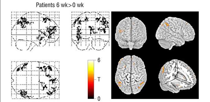 neuronal activity Patients treated with antipsychotics for 6 wks