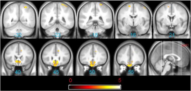 Gray Matter Loss Is Worse in Patients With a Longer Duration of Untreated Psychosis Colored voxels depict brain areas of significantly greater gray matter loss