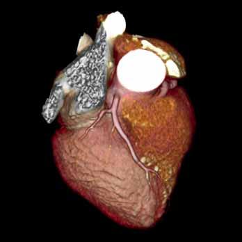 Cardiac A 55-year-old female patient presented with