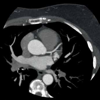 A cardiac CT scan was made to rule out coronary