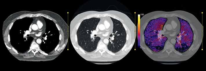 Lung embolisms were found on the right and left side.