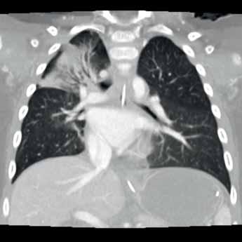 Pediatric A CT scan of the thorax was performed in