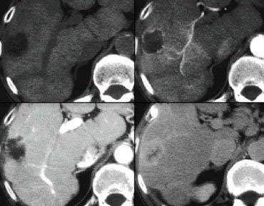 Hemangioma Aial C+ CT (Various phases) Film Findings: Hypodense lesion with