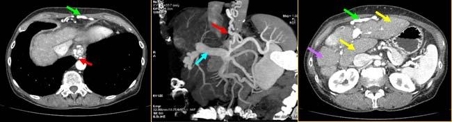 PS: Cirrhosis and Portal Hypertension Film Findings: Nodular, shrunken liver Caudate and left lateral lobe enlargement Esophageal Varices Umbilical