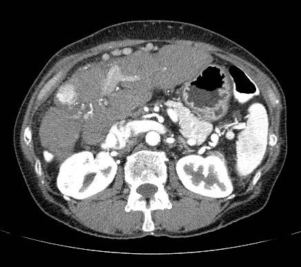 PS: Triple Phase CT Aial C- CT Aial C+ CT: Arterial Phase Film Findings: