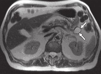 Khan et al. Fig. 2 MRI of pancreatic pseudocyst.