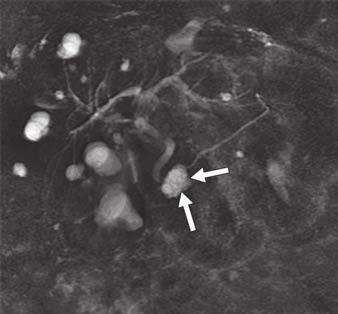 Fig. 5 MRI of serous cystadenoma., Heavily T2-weighted coronal thick slab MRCP image shows high-signal-intensity lesion (arrows) at junction of head and body of pancreas (cluster of small cysts).