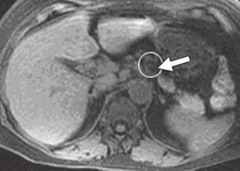 These tumors dilate the affected side branch with mucin, producing the appearance of a pleomorphic cystic pancreatic mass that communicates with the main duct.