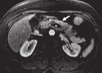 14C). Complex cystic areas representing internal tumor necrosis or side-branch ductal obstruction may be seen.