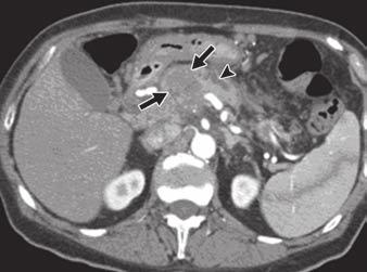 Khan et al. Fig. 14 CT of adenocarcinoma with cystic degeneration.