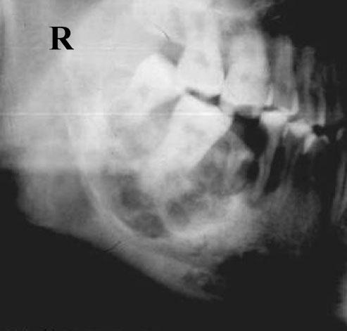 60 Y Liu et al Figure 2 Case 8. Panoramic radiograph showing a multicystic lesion with the resorption of the affected teeth roots. Some honeycombed septa are scattered in the lesion.