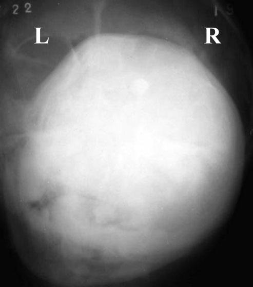7 Some OFs do, in fact, contain prevalent cementum-like calcifications and others show only bony material, but a mixture of the two types of calcification is commonly seen in a single lesion.