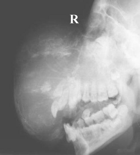 Left lateral cephalometric projection. The radiographs in Figures 8 and 9 demonstrate that the tumour involved the bilateral jaw bone.