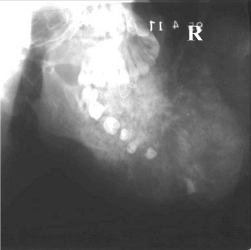 However, for the early cases no CT scanning was available in the hospital and the similar radiological appearance of the tumour in the jaw bone may of confused the diagnosis of
