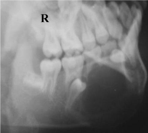 62 Y Liu et al Figure 12 Case 20. Panoramic radiograph showed a high-density mass expanded downward and the affected teeth leaned toward the lesion area in 2000 Figure 10 Case 20.