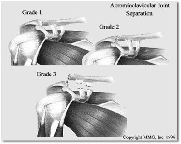 Acromioclavicular (AC) Separations of the Shoulder Fall on to tip of shoulder, adducted arm Very painful