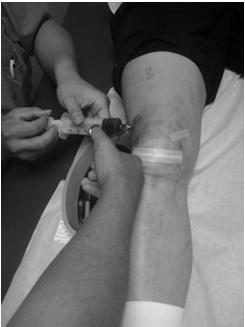 injury Knee Injections (DJD) 1 cc