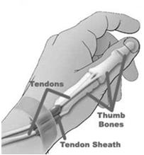 DeQuervain Tenosynovitis Carpal-MC Joint of the