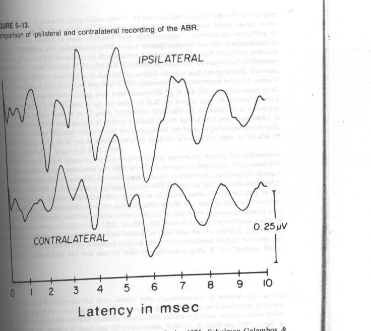 ABR Indices in Retro-cochlear Lesions I. Latency Indices 1- Interpeak latencies (IPL): The most powerful index. I-V IPL is usually 4.0 msec (sd 0.2 msec). I-III IPL is slightly above 2.