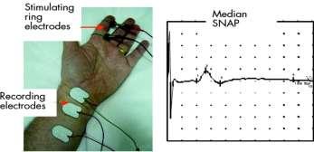 SNAP: Sensory Nerve Action Potential Figure 2 Median orthodromic sensory study.