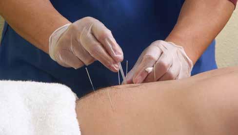 Will acupuncture work for me? Physiotherapists use acupuncture for a number of reasons, mainly to reduce pain.