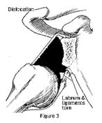 The capsule, ligaments, or labrum can be stretched, torn, or detached from the bone.