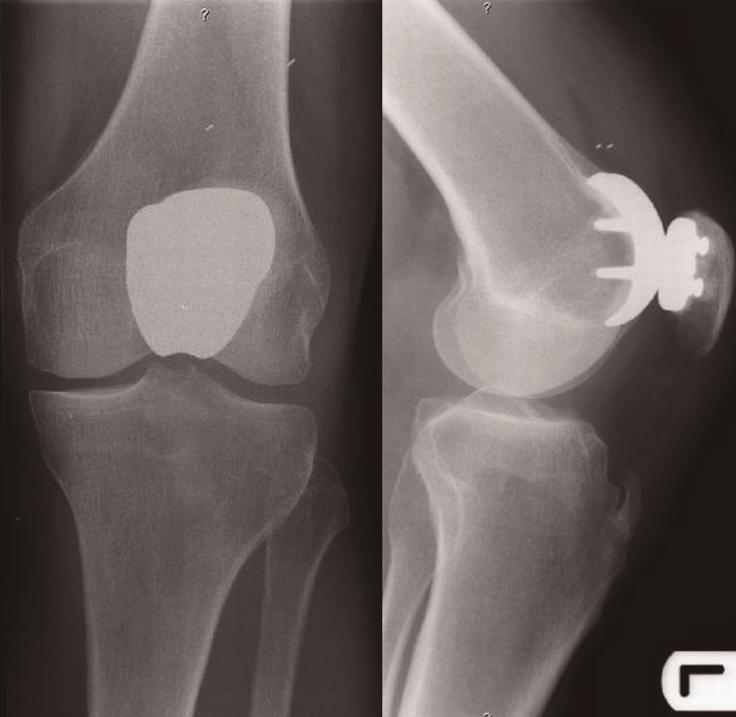 Cases Journal 2009, 2:7502 the Low Contact Stress Patellofemoral Joint Replacement prosthesis.