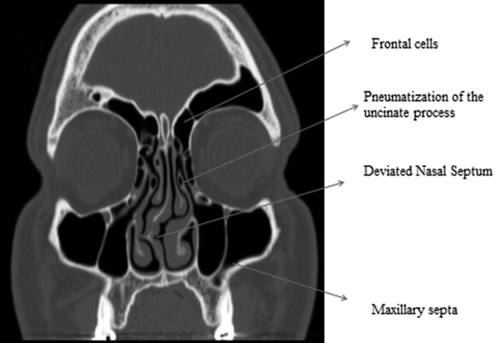 study, there was no significant correlation between hypertrophic ethmoidal bulla and sinusitis of anterior ethmoid.