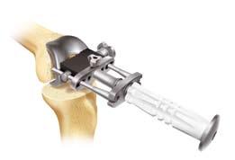 Step 9 - Femoral Component Trial Position the selected size AGC femoral trial onto the resected bone, using the femoral