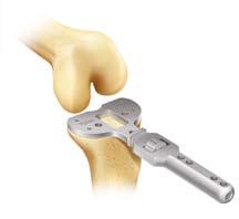 Note: If additional bone removal is necessary, place the block over the pins using the upper holes to remove an extra 2mm of bone.