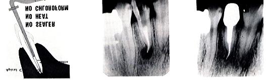 The root canal must be made completely dry with a suction paper point and a heat carrier in this method a rubber dam must be used for the prevention of various troubles and moisture by breathing.