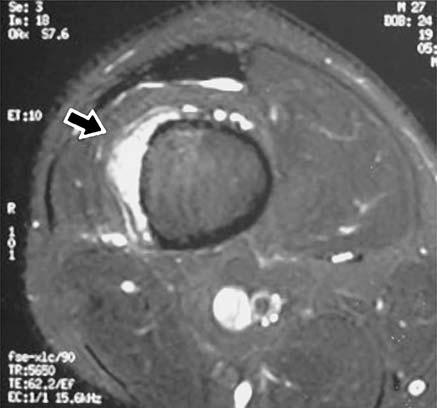Case history A 27-year-old man experienced right knee pain after a mild trauma for which he did not receive treatment.