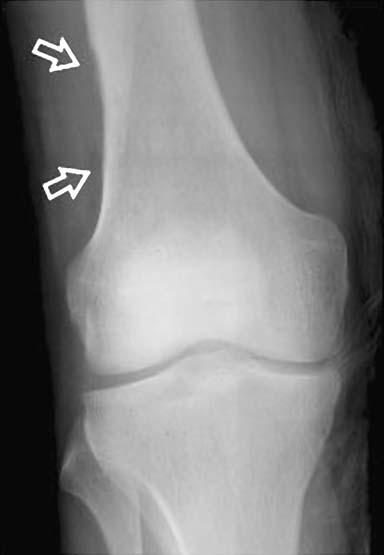 According to the patient, MR imaging was done and was negative. Six months later, he had acute pain in the right knee, which prompted performing radiographs and MR imaging.